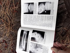 Rockwood Fractures in Adults & Children 2nd Ed Complete 3 Vol Set HC Orthopedic