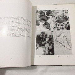 Vintage Medical Book Cancer Pathology Cytology of Effusions Spriggs Color Plates