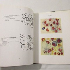 Vintage Medical Book Cancer Pathology Cytology of Effusions Spriggs Color Plates