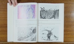 Atlas of Pulmonary Pathology 3885810212 Morgenroth, Newhouse, Nolte 1982