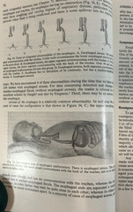 The Surgery of Infancy and Childhood, Gross, 1953, E-119