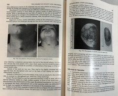 The Surgery of Infancy and Childhood, Gross, 1953, E-119