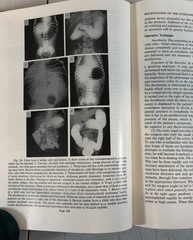 The Surgery of Infancy and Childhood, Gross, 1953, E-119